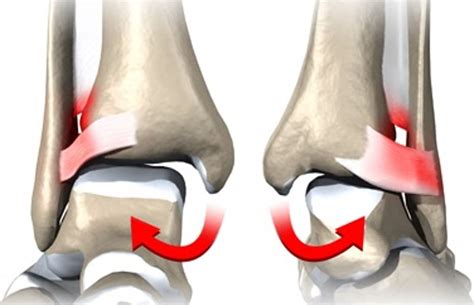 test for interosseous membrane tear|High Ankle Sprain & Syndesmosis Injury .